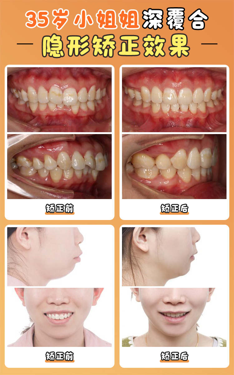 六、写在末尾：整牙不是消费，是性价比更高的“变得更美投资”