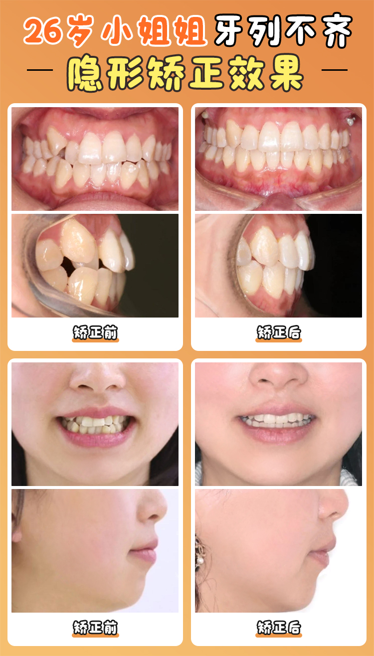 徐寶華正畸臨床成果：3萬例成功病例背后的技術邏輯