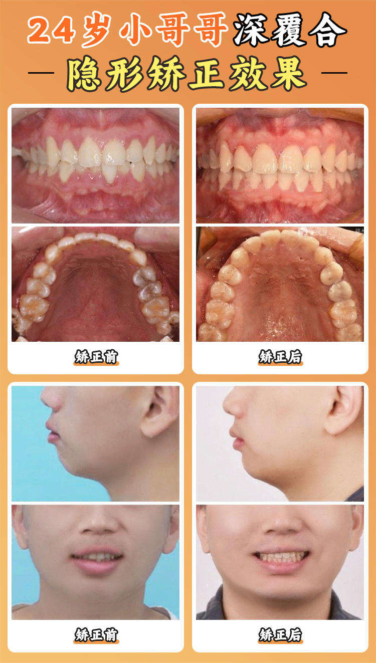 七、行業(yè)視角：周彥恒爭(zhēng)議背后的正畸市場(chǎng)亂象