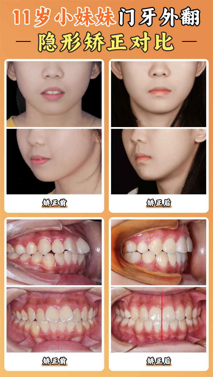 江久匯正畸收費怎么樣？2025年北大口腔價目表詳解