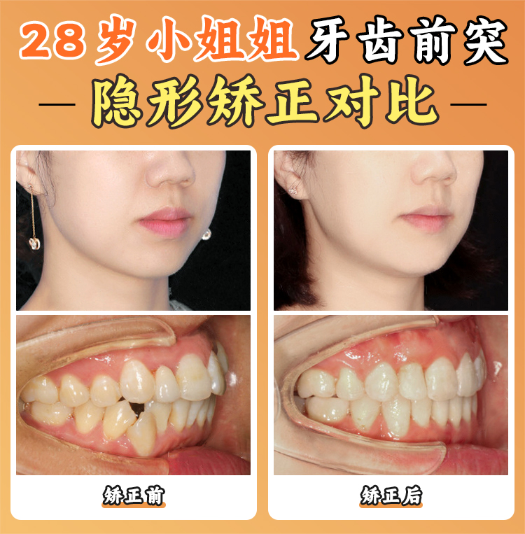 徐寶華正畸技術(shù)實(shí)力：30年深耕，舌側(cè)矯正與顏面美學(xué)雙具有影響力