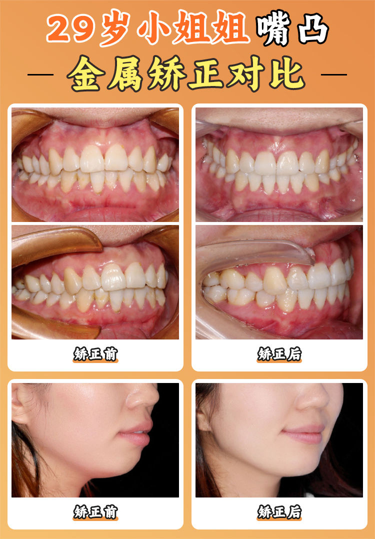 周彦恒牙医西安正颌案例亮眼，正颌正畸联合/数字化隐形矫治技术揭秘，坐诊医院及预约方式快了解