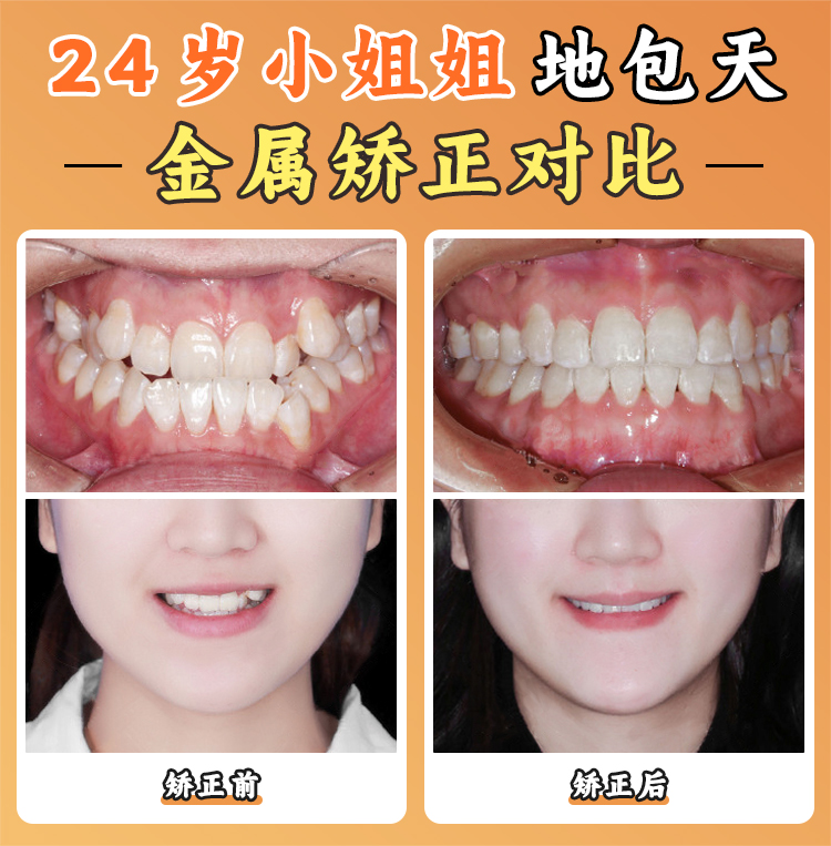 周彦恒牙医西安正颌实例纪实:骨性龅牙/地包天患者的“换脸”之旅,真实反馈看成效!