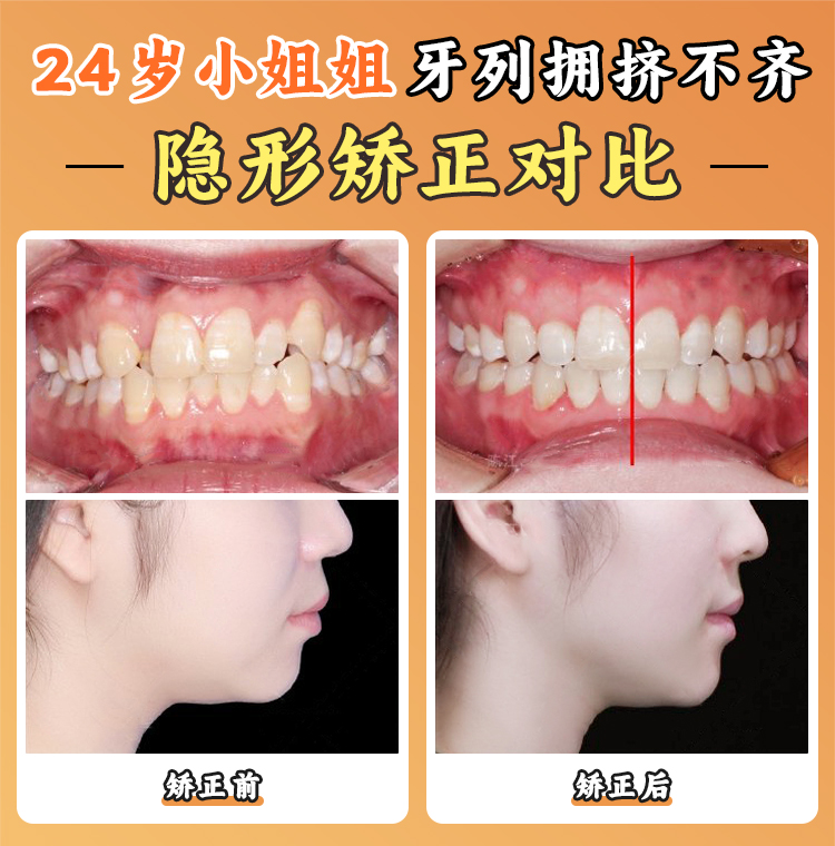 周彦恒牙医西安收费标准:正畸/正颌多少钱?透明化报价让你不踩坑!