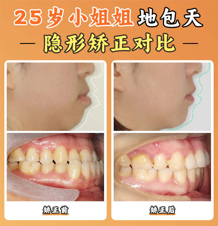 周传丽医生正畸怎么样？隐适美技术与数字化诊疗助力，在线资讯助你轻松了解怎么面诊