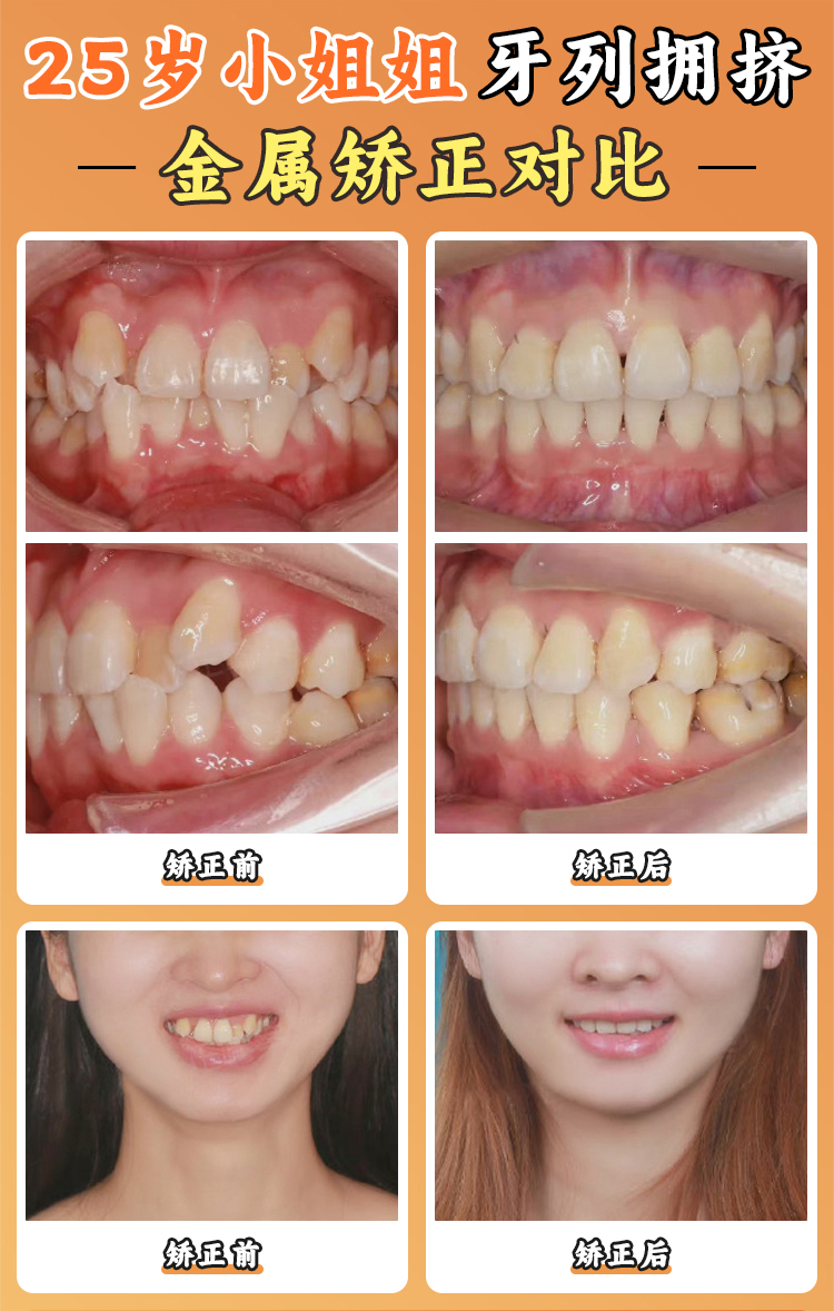 周传丽医生隐形矫治技术怎么样？隐适美认证骨干医生的精细方案