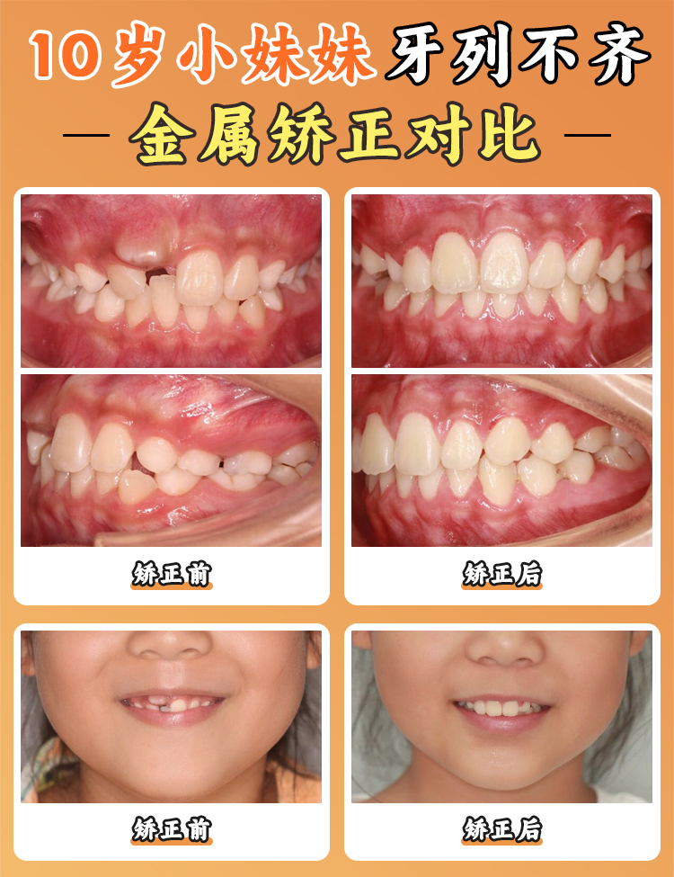 周传丽医生正畸口碑怎么样？从儿童到成人的100%满意度见证