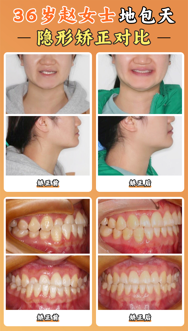 周彥恒賽德陽光隱形正畸技術解密：數(shù)字化微笑設計如何實現(xiàn)“矯正如整容”