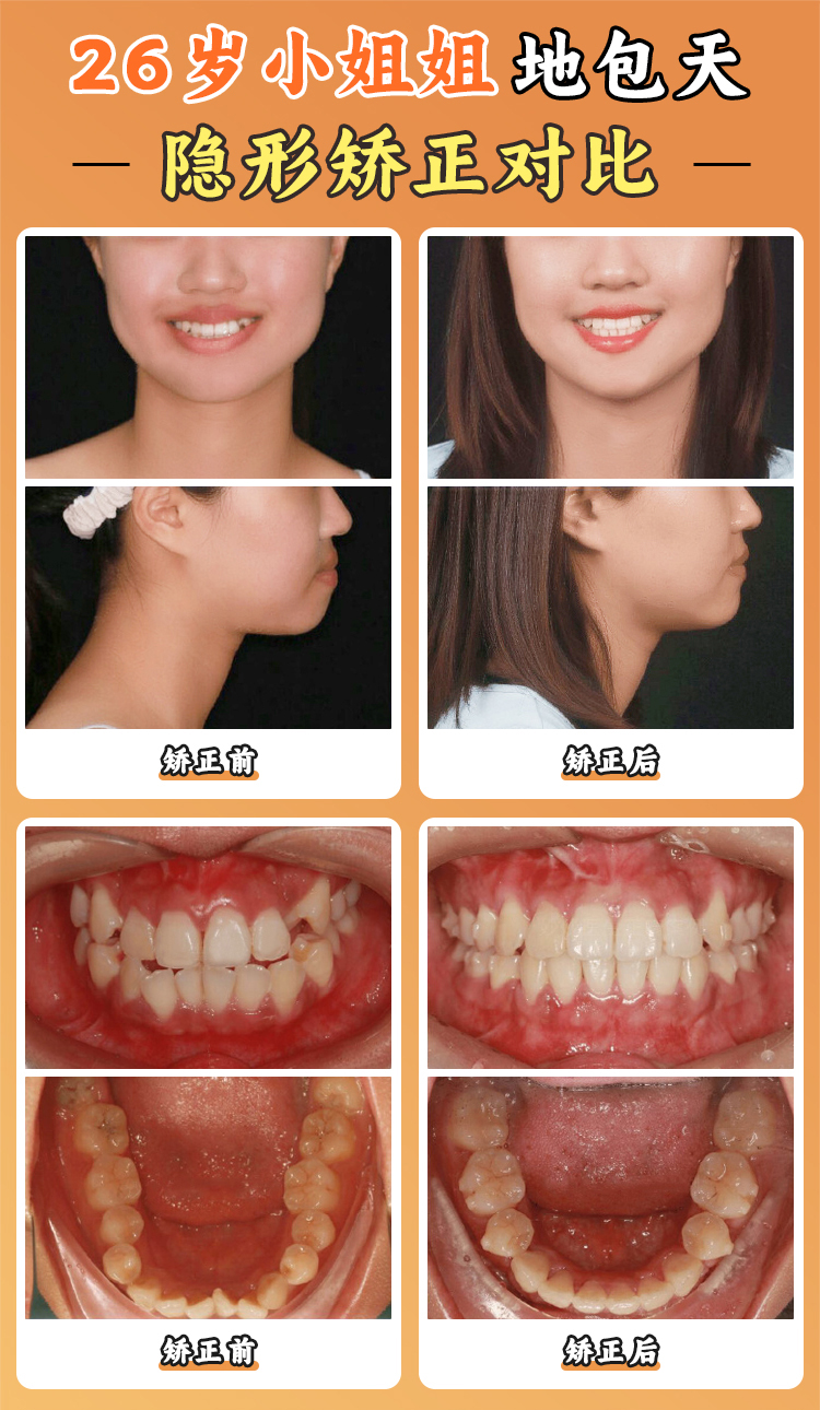 周彥恒正畸多少錢起步？金屬托槽8千起丨隱形矯正3萬(wàn)起且數(shù)字化技術(shù)優(yōu)