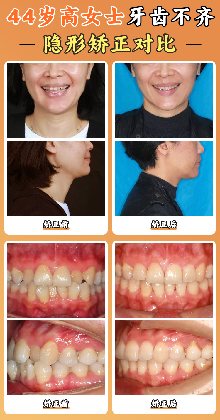 八、总结:周彦恒正畸多少钱起步?