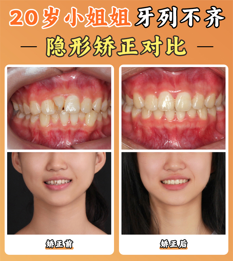 徐寶華正畸怎么掛號？3步搞定電話預約與官網(wǎng)流程，舌側(cè)矯正8萬起憑“東方人個性化技術(shù)”口碑佳