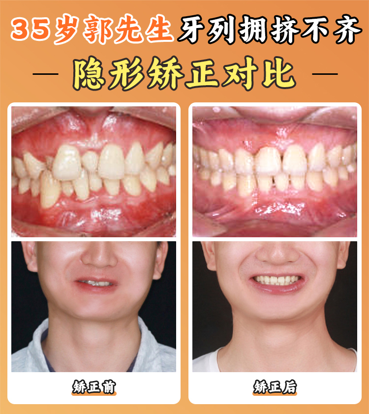 徐寶華正畸搶號技巧：國有撿漏+私立加急通道