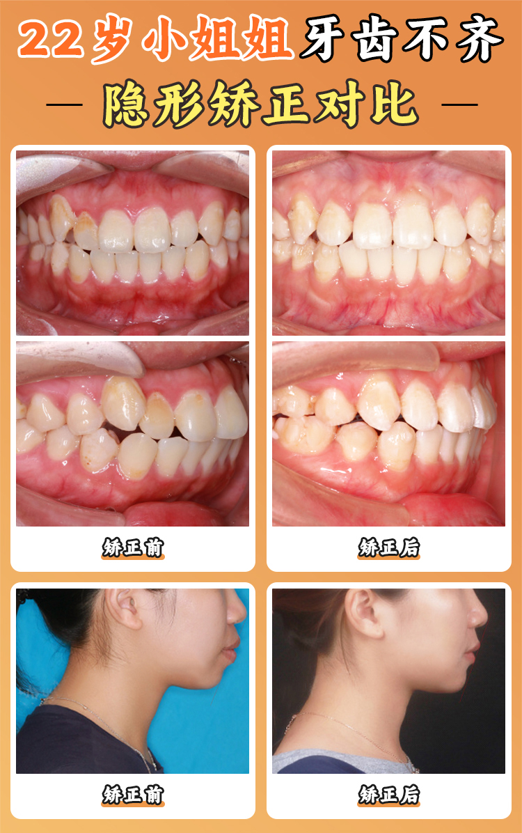 徐寶華正畸口碑怎么樣？患者真實實例反饋