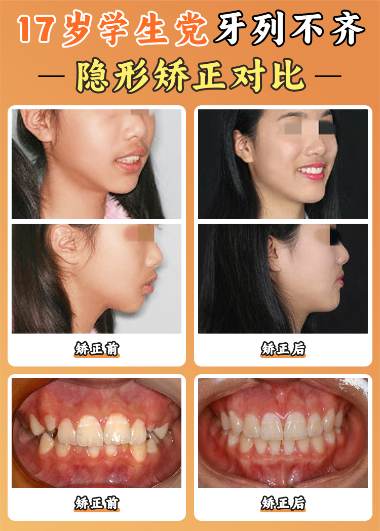 賈培增正畸技術(shù)優(yōu)勢：舌側(cè)隱形矯正與睡眠呼吸暫停矯治創(chuàng)新成果