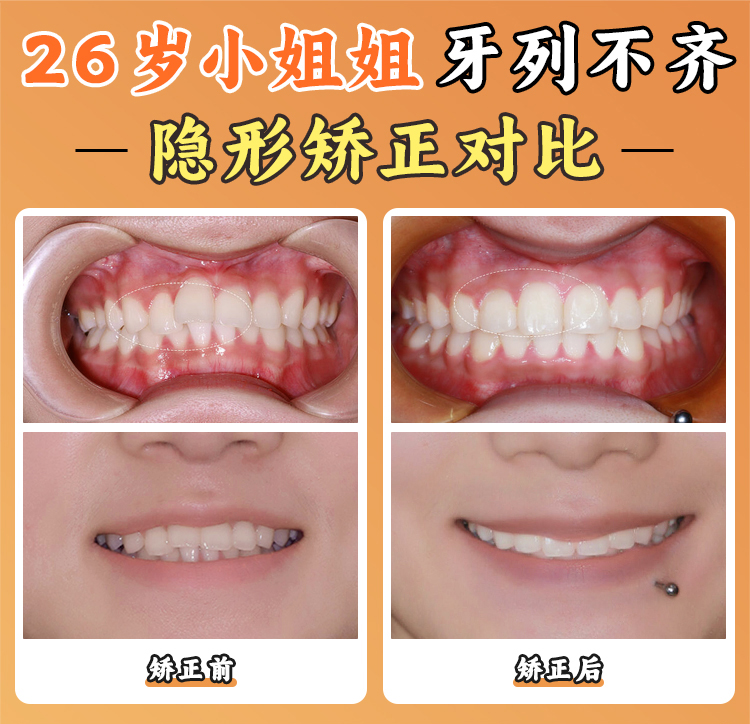 賈培增正畸收費標(biāo)準2025：項目價格明細與醫(yī)療保險政策