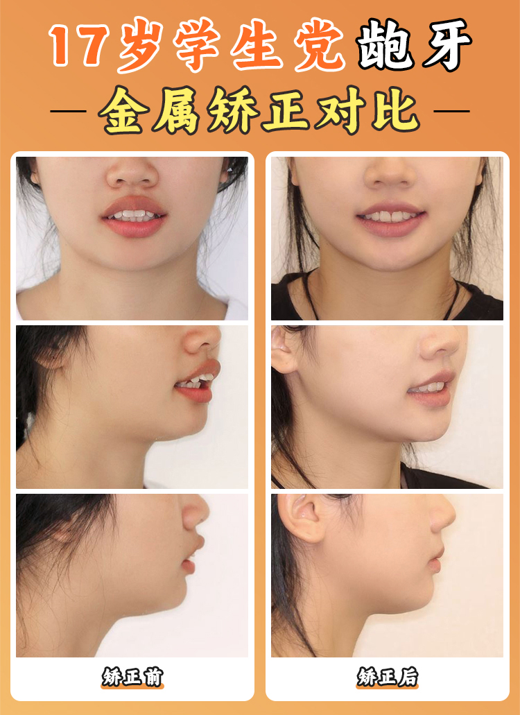 徐寶華正畸費用一覽表：國有私立價格對比與省錢妙招