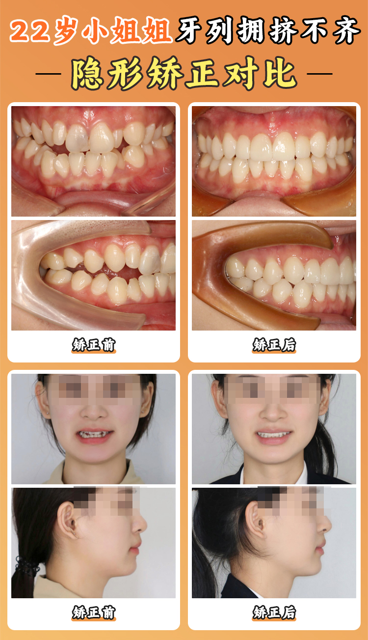 吴尽红医生对比吴红宣医生，成人复杂正畸病例处理能力谁更突出？