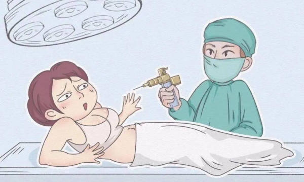 罗明生医生的分层吸脂