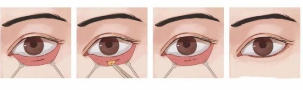 八大处郭鑫去眼袋费用