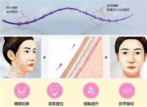 谢宏彬医生拉皮