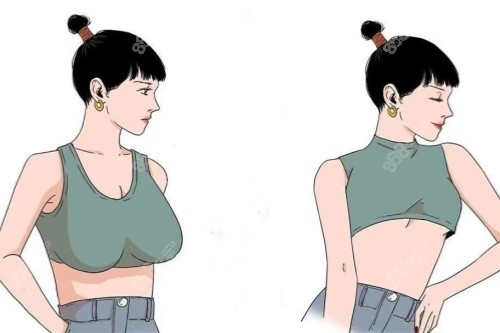 北京贺天遥医生丰胸