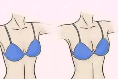 北京贺天遥医生丰胸