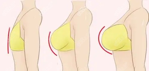 北京贺天遥医生丰胸
