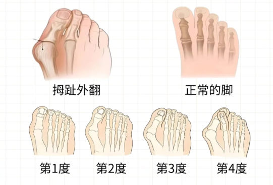 北京廣濟(jì)拇外翻醫(yī)院3位患者的真實(shí)體驗