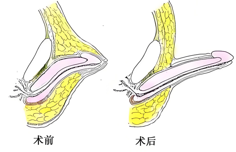 張國喜男性生殖整形價格表