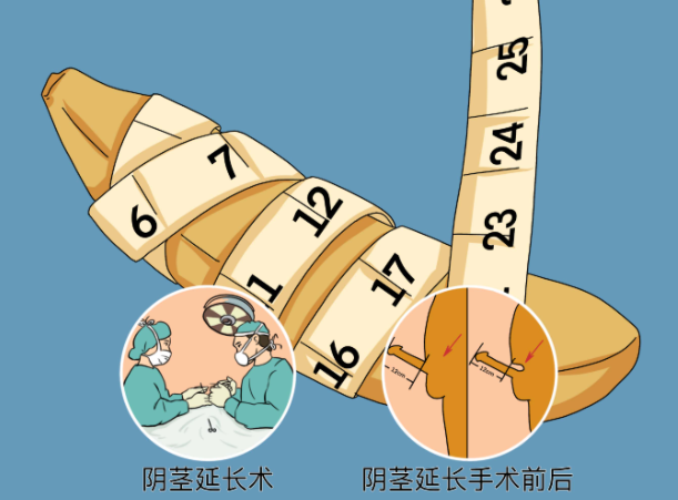 張國喜男性生殖整形價格背后的手術優(yōu)勢