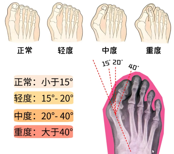 孙卫东拇外翻手术术后6周，患者变好得怎么样