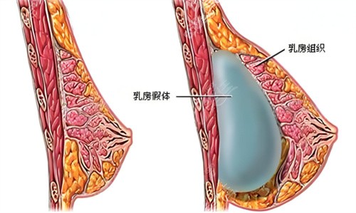 假体隆胸术原理图.jpg