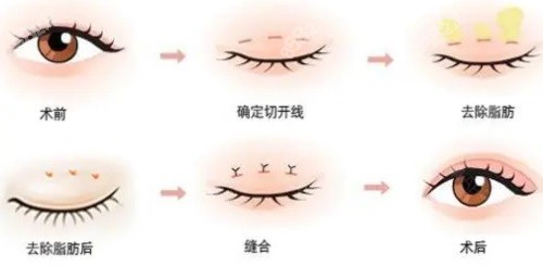 双眼皮手术过程图.JPG
