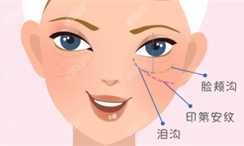 泪沟卡通图.jpg