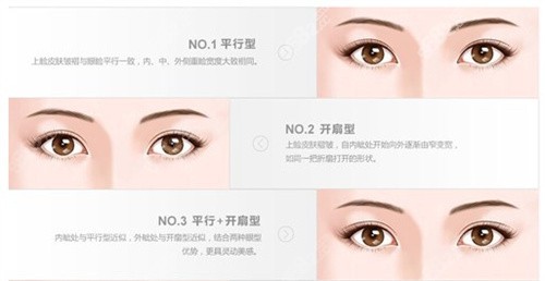 双眼皮的类型.jpg