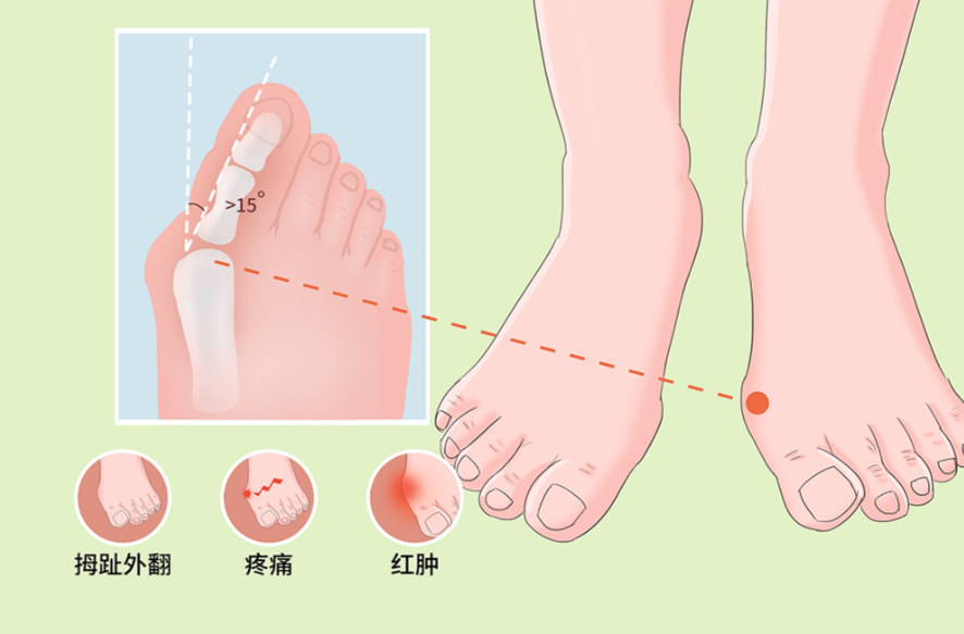 溫建民做拇外翻沒(méi)有黑料