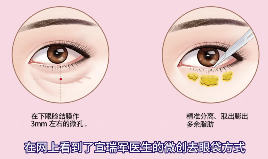 深圳朱冠峰眼袋手術(shù)預(yù)約