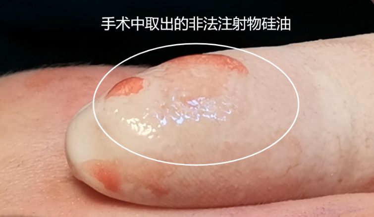 白馨月注射异物取出实例
