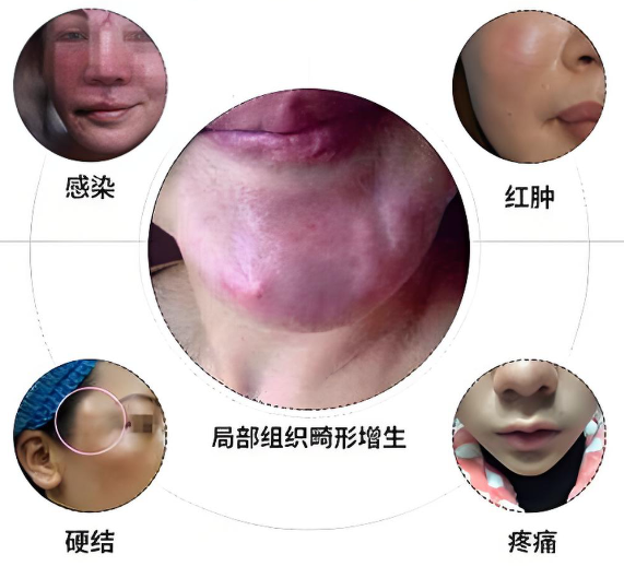 为什么选白馨月做注射异物取出