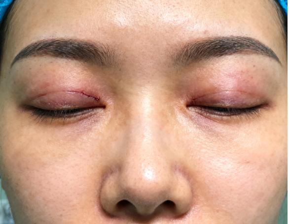实例一:三眼皮/多层褶 + 闭眼不全