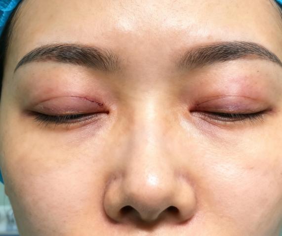 实例三:眼袋术后外翻/退缩/凹陷
