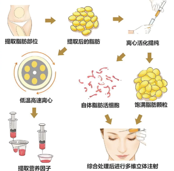 抽脂过程图