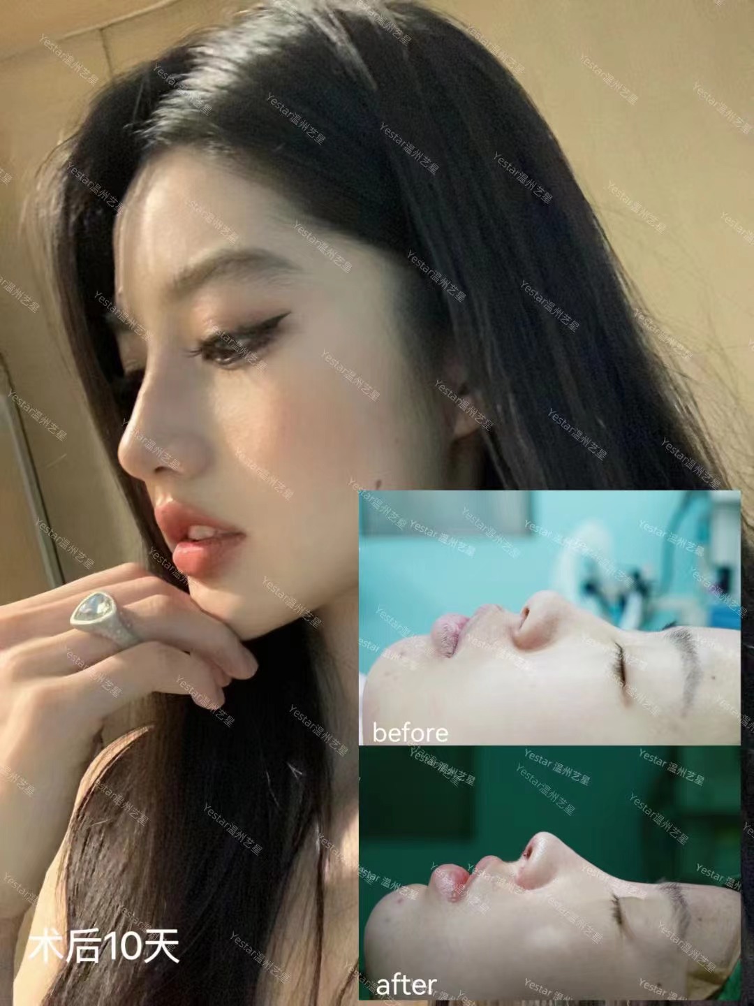 南京馮思陽做鼻子長期成效怎么樣？三年老鼻子反饋！馮醫(yī)生做的肋骨鼻現(xiàn)在還能隨便揉