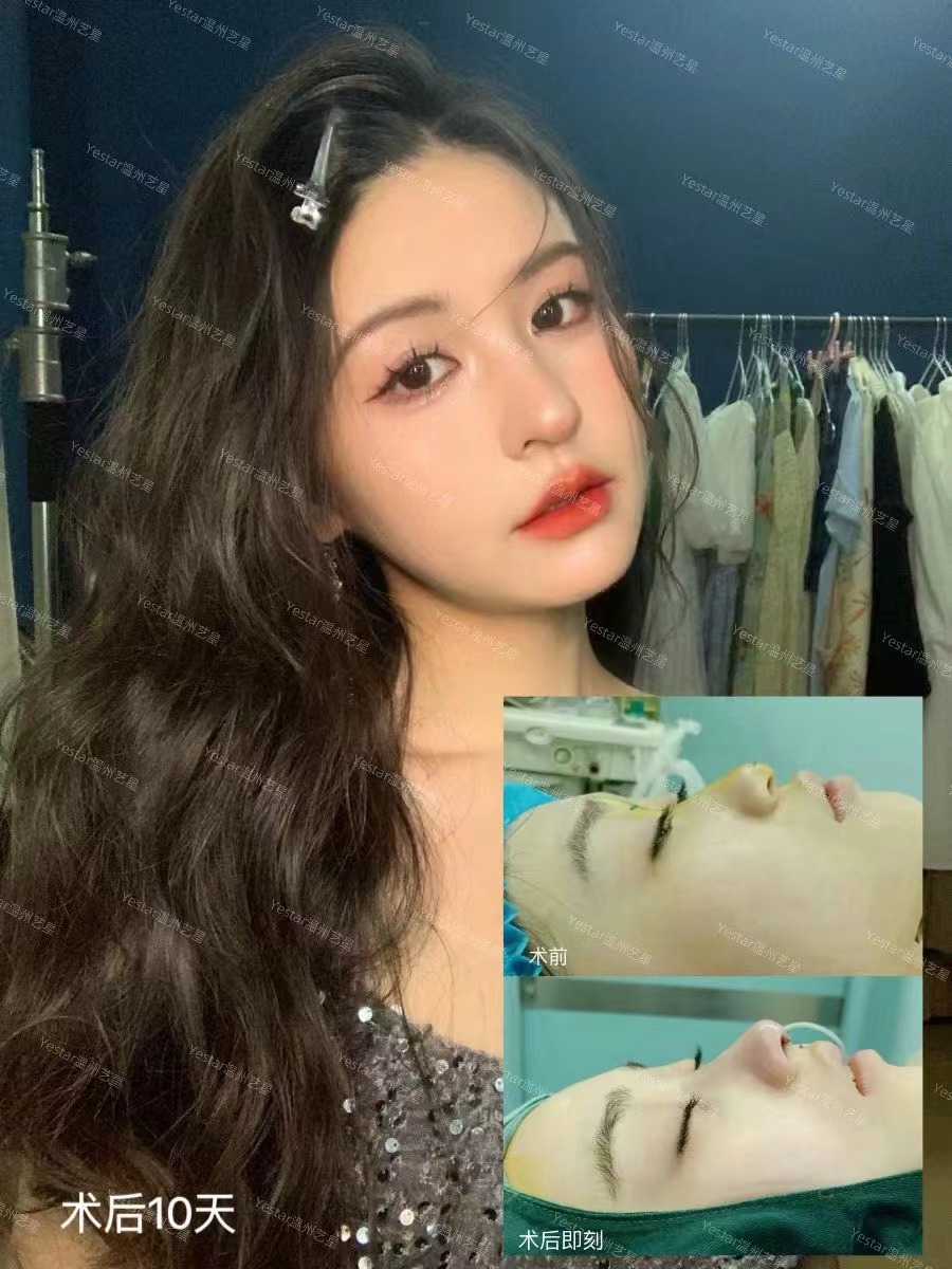 2025王先成鼻修复价格多少?揭秘鼻尖与鼻翼修复不同价位