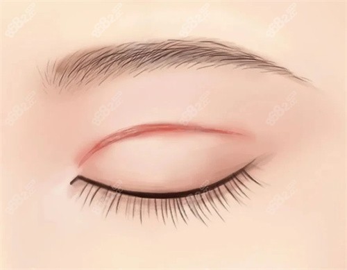 20251028664359.jpg 雙眼皮的術(shù)后疤痕.jpg