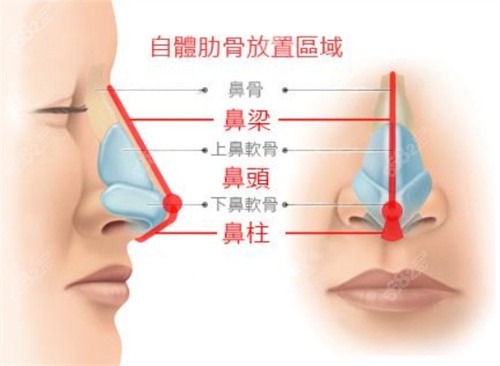 20251028785583.jpg 鼻部整形示意圖.jpg