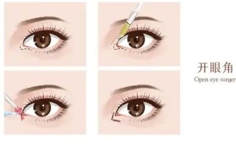 杜園園醫(yī)生難預(yù)約嗎？揭秘金刀獎(jiǎng)評(píng)委的快速預(yù)約技巧+真實(shí)案例分享