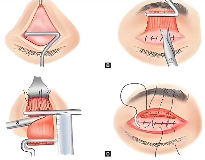 上海舒情雙眼皮無需避雷有證是正規(guī)醫(yī)生