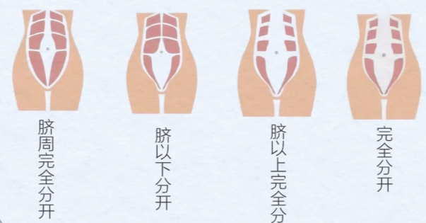 很多人问“腹壁整形疼吗?变好期长吗?”李献和医生给出解答: