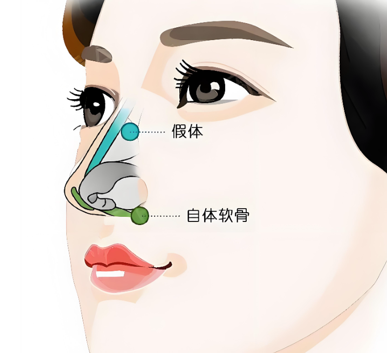 戴傳昌鼻子凹陷能整回去嗎